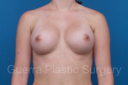 next Case #1002185 After