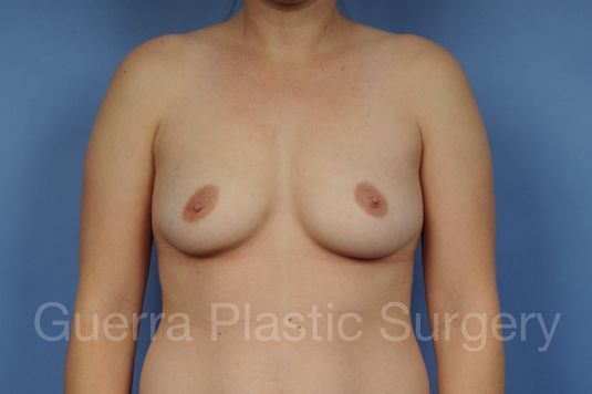 next Case #1002187 Before