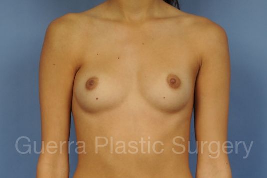 next Case #1001184 Before