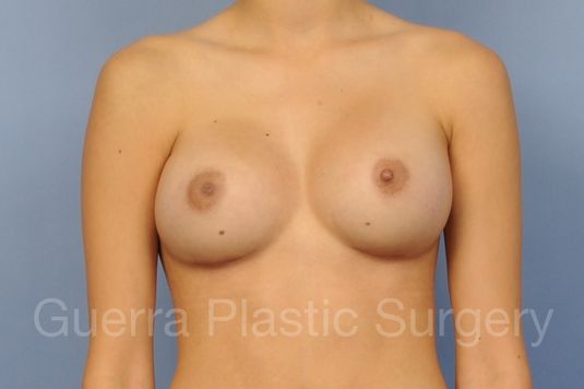 next Case #1001184 After