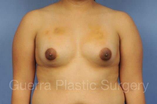 next Case #1001186 Before