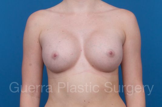 prev Case #21282 After