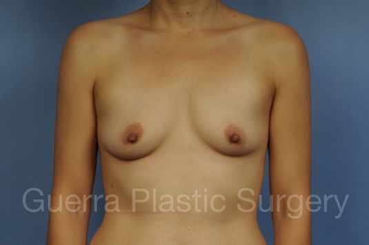 next Case #1001189 Before