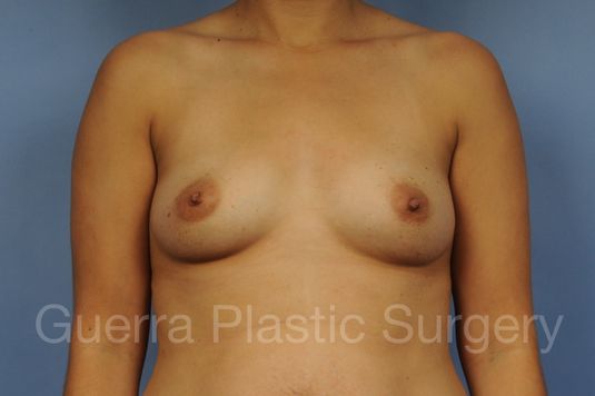 next Case #1001190 Before