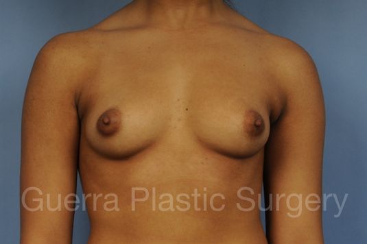 prev Case #1001191 Before