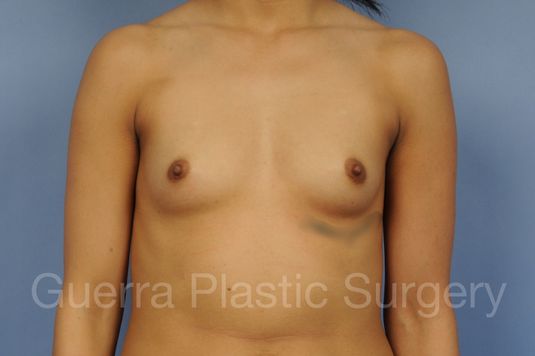 next Case #1001192 Before