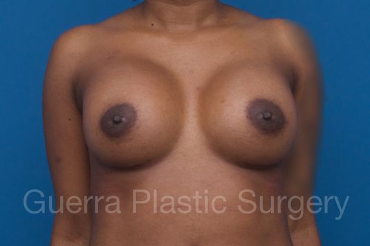 prev Case #1001200 After