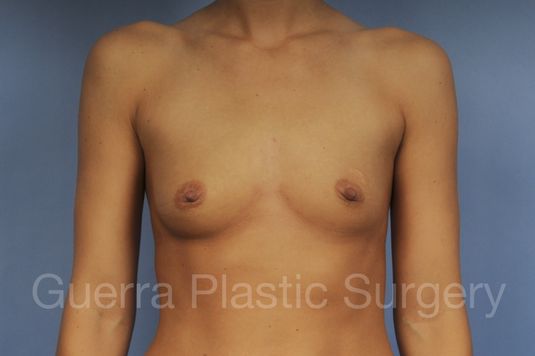 next Case #22038 Before