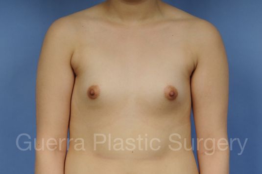 next Case #1001203 Before