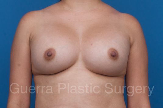 prev Case #1001207 After