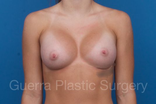 prev Case #1001209 After