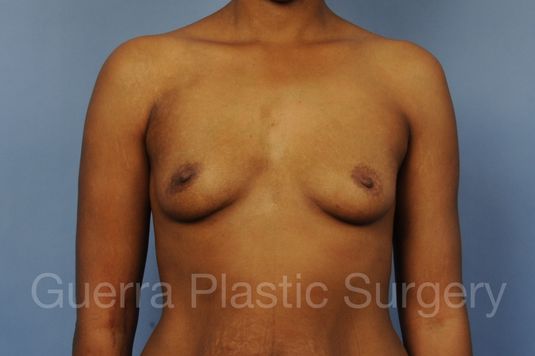 next Case #1001211 Before