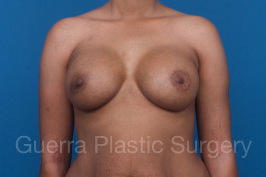 next Case #1001211 After