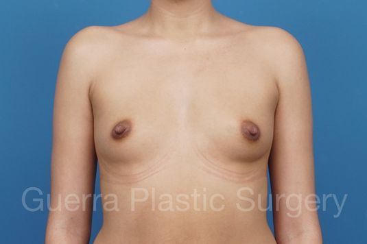 next Case #29290 Before