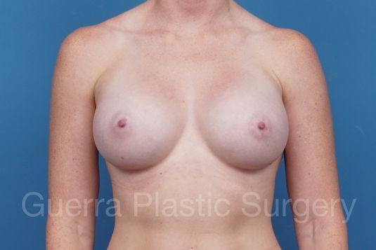 next Case #1006005 After