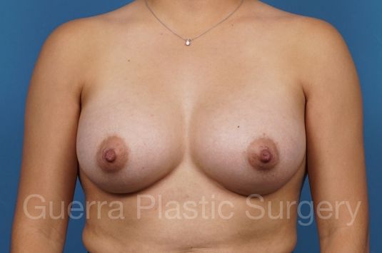 prev Case #35401 After