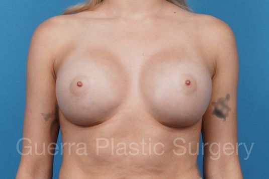 prev Case #41248 After