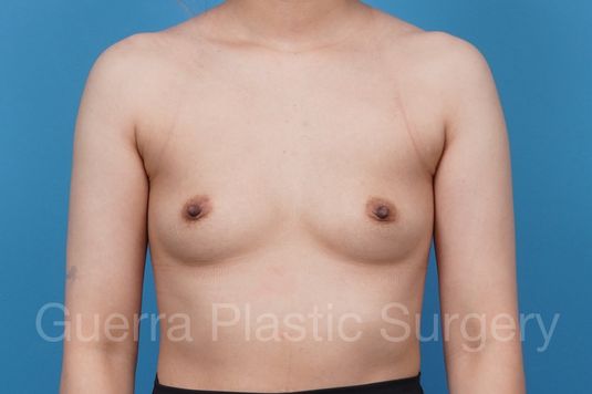 next Case #41281 Before