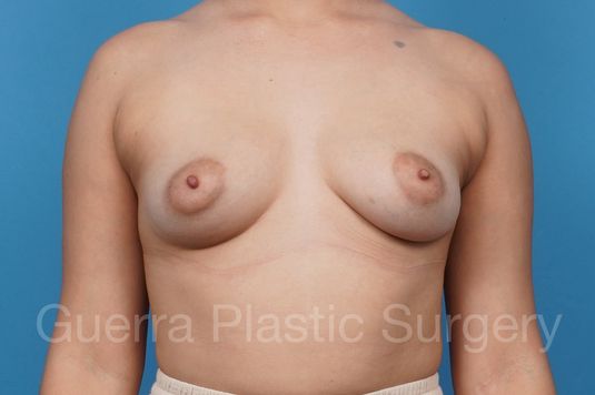 next Case #42883 Before