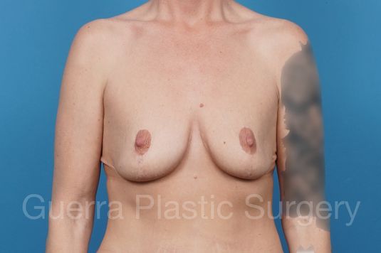 next Case #41904 Before