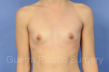 next Case #96532 Before