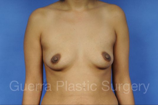 prev Case #1001001 Before