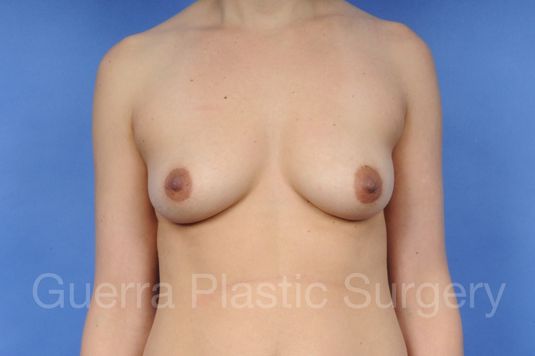 next Case #1001021 Before