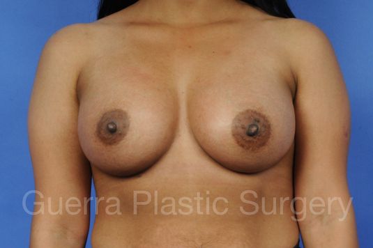 prev Case #1001023 After