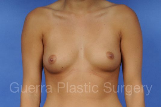 next Case #1001025 Before