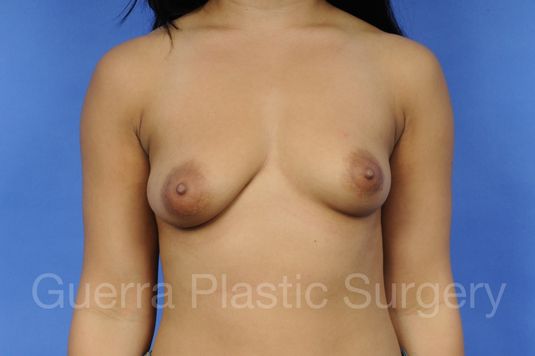 next Case #1001035 Before