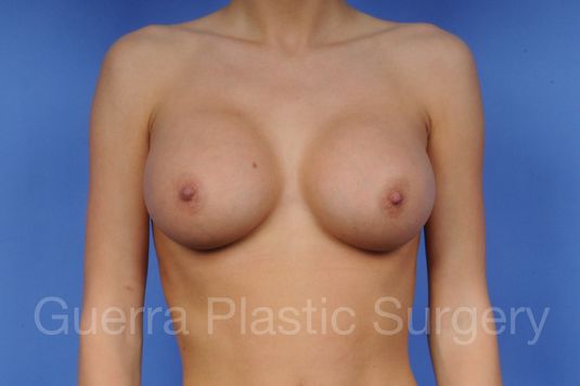 prev Case #1001041 After