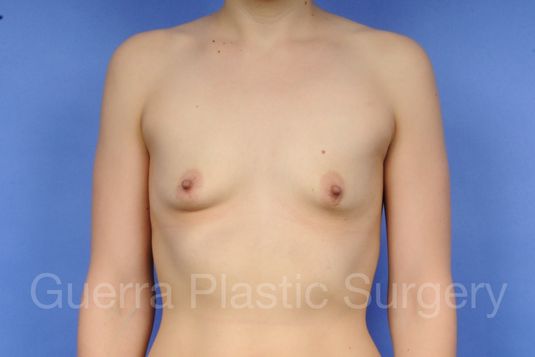 next Case #1001043 Before