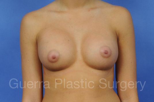 next Case #1001062 After