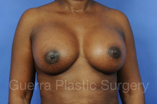 prev Case #1001071 After