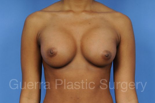 prev Case #1001079 After