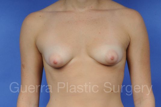 next Case #1003002 Before