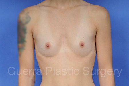 next Case #1003003 Before