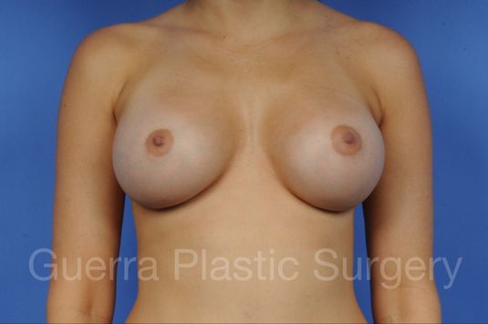 next Case #1003005 After