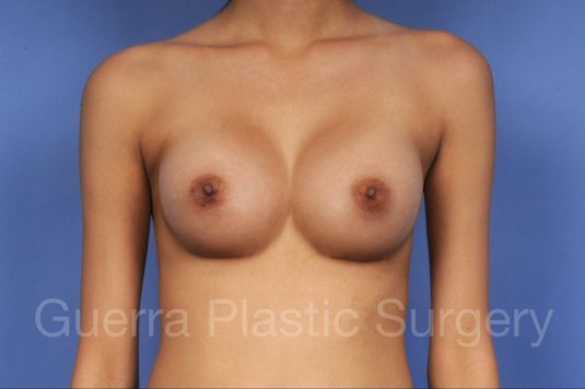 prev Case #1002015 After