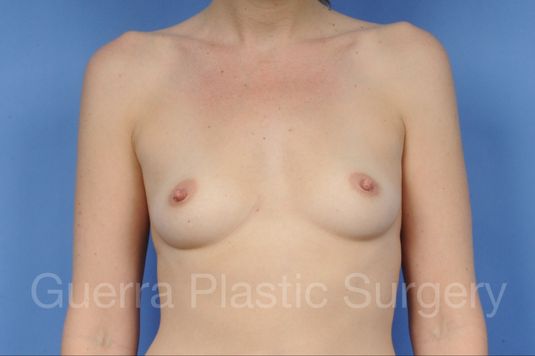 next Case #1002016 Before