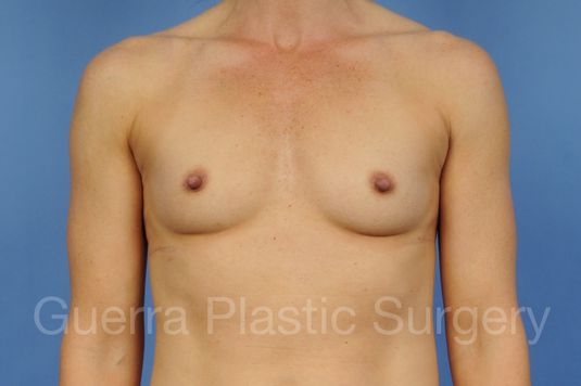 next Case #1002012 Before