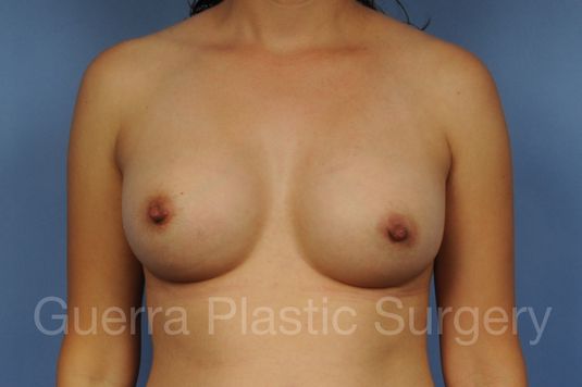 prev Case #100201104 After