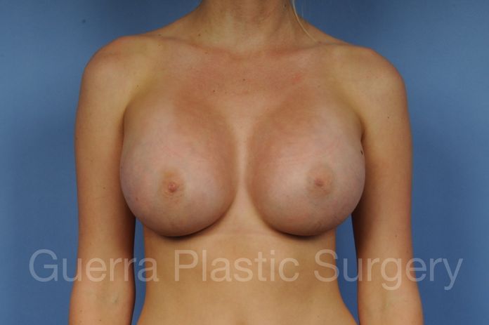 Breast Augmentation Case #1003015 - after