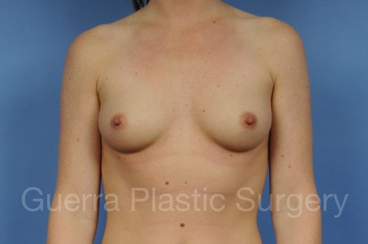 next Case #1001120 Before