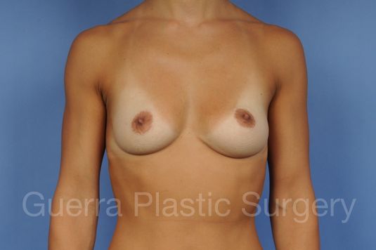 next Case #1002047 Before