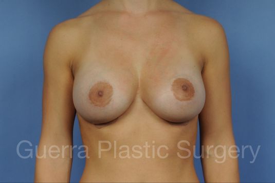 next Case #1002047 After