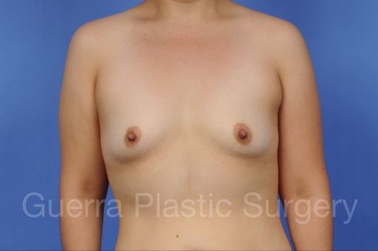 next Case #1003016 Before