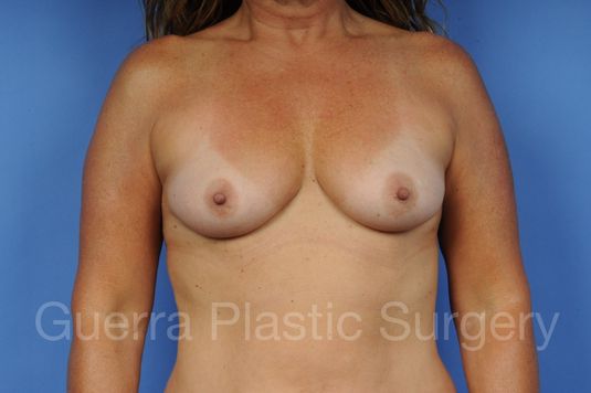 prev Case #1004004 Before