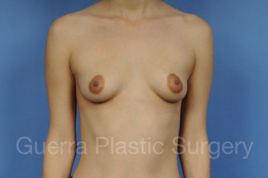 next Case #1003017 Before