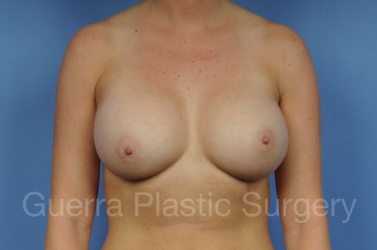 prev Case #1001093 After